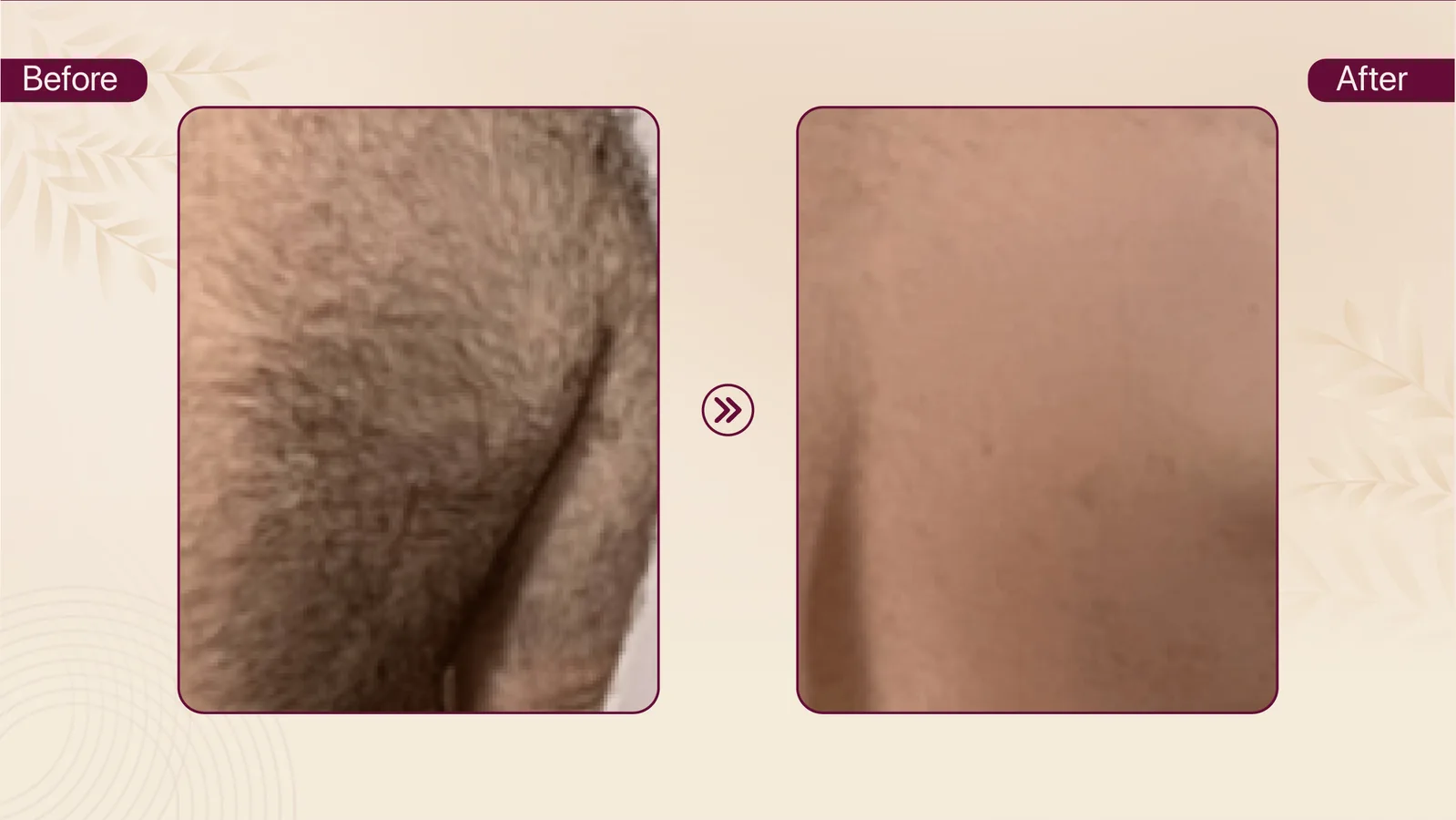 Precision hair removal before and after result