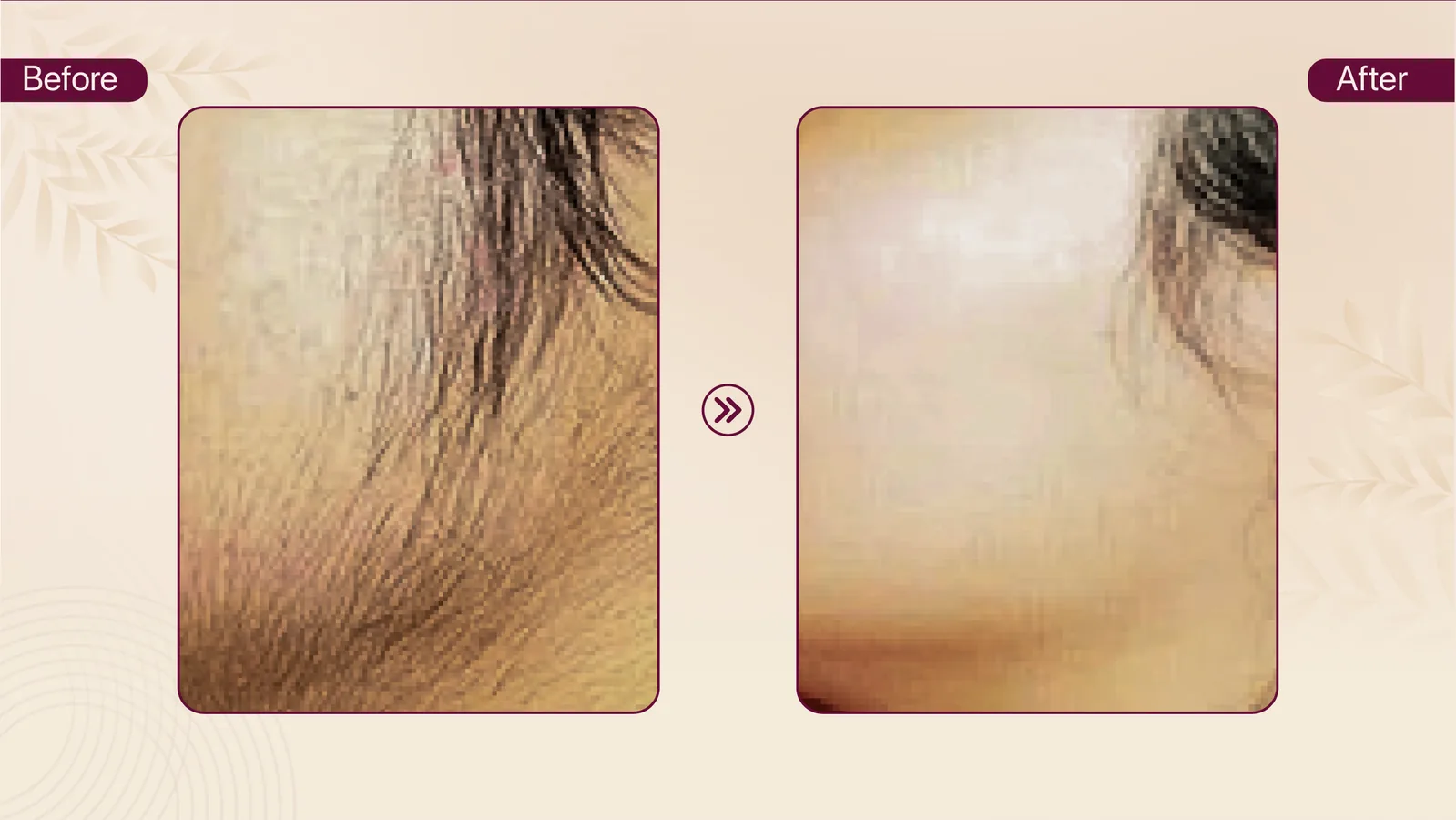 Targeted hair removal before and after result