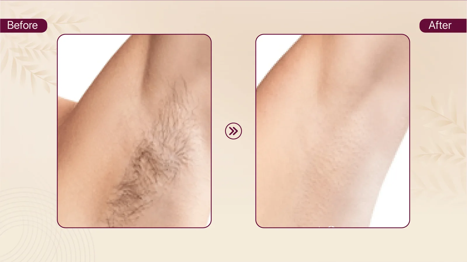 Underarm hair removal before and after result