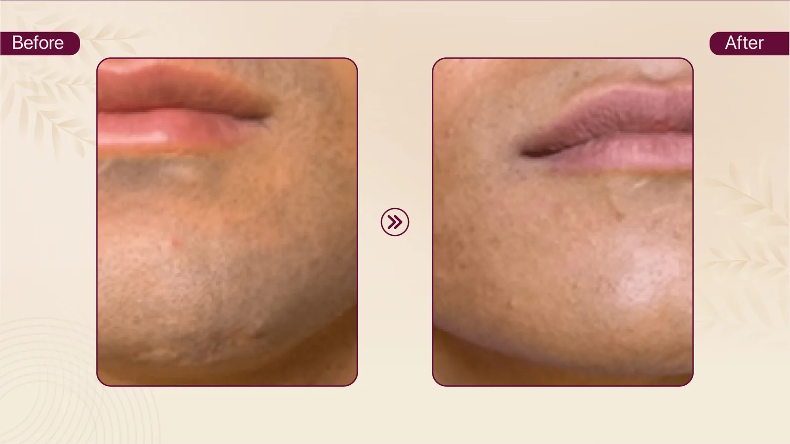 Facial hair removal before and after result
