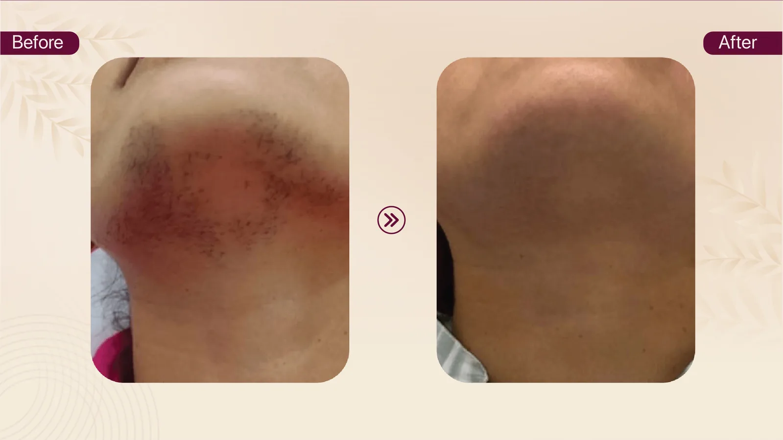 Chin hair removal before and after result