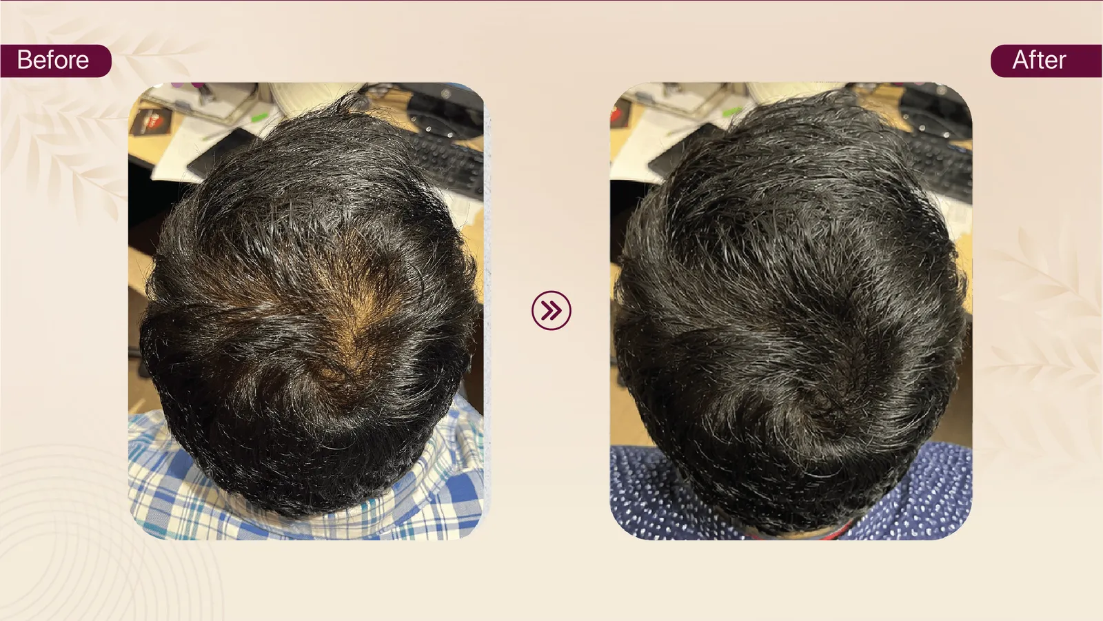 Hair density treatment result for crown thinning