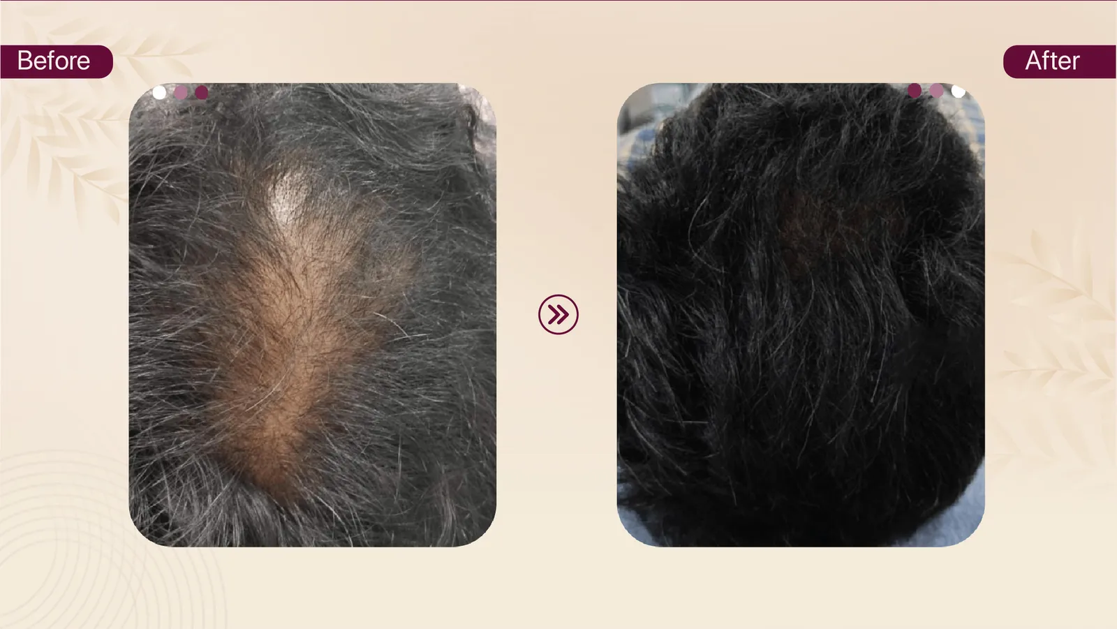 Female hair thinning treatment result