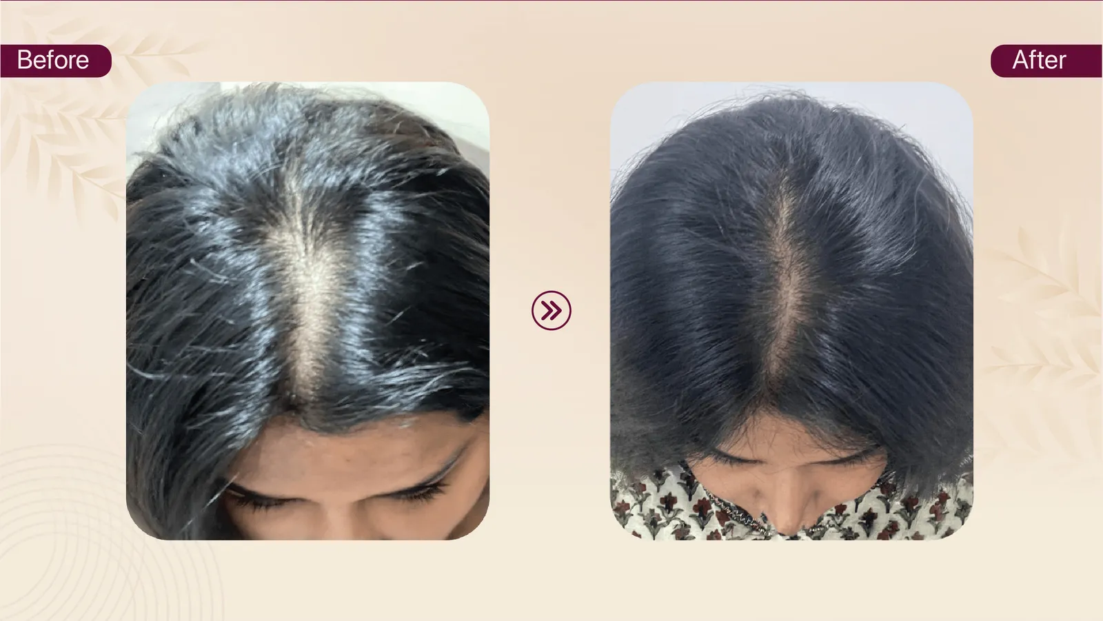 Hair density improvement journey