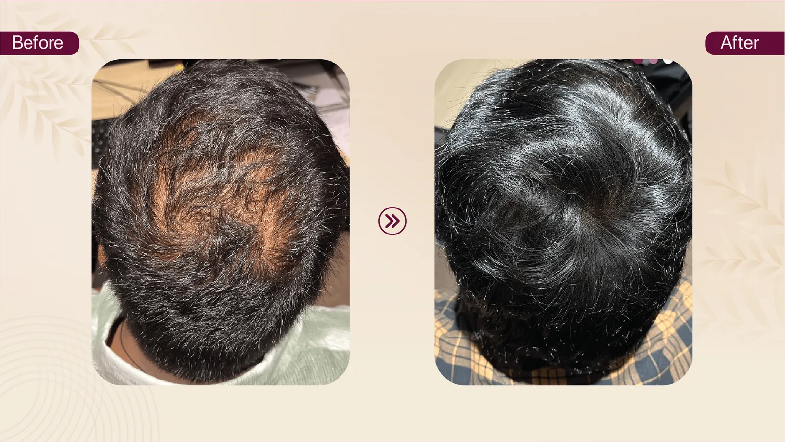 Crown hair density treatment journey