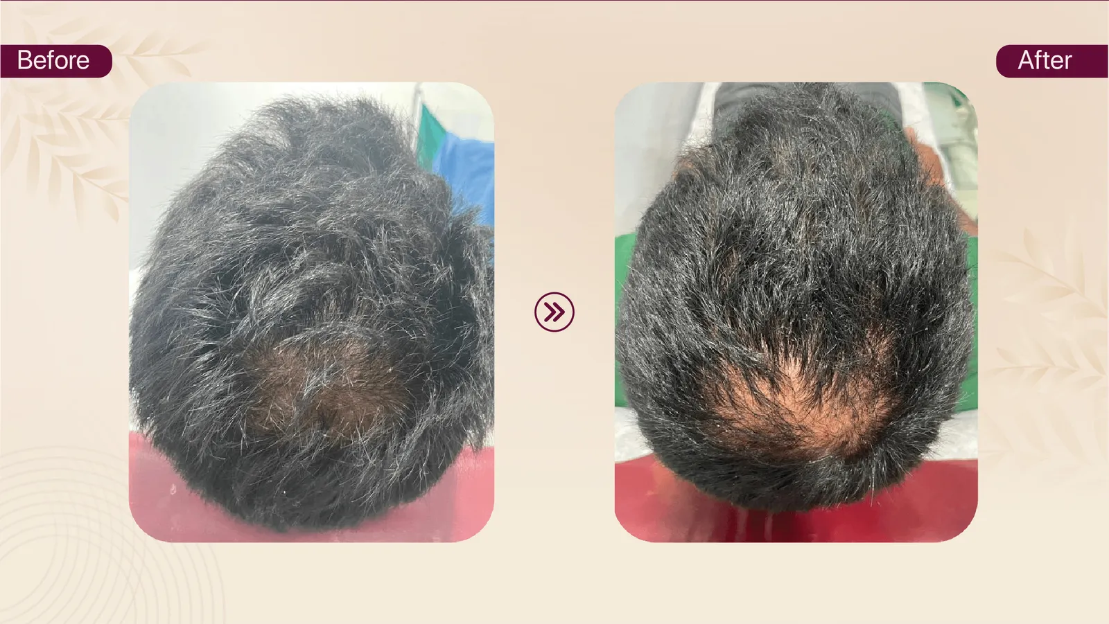 Male hair thinning treatment journey