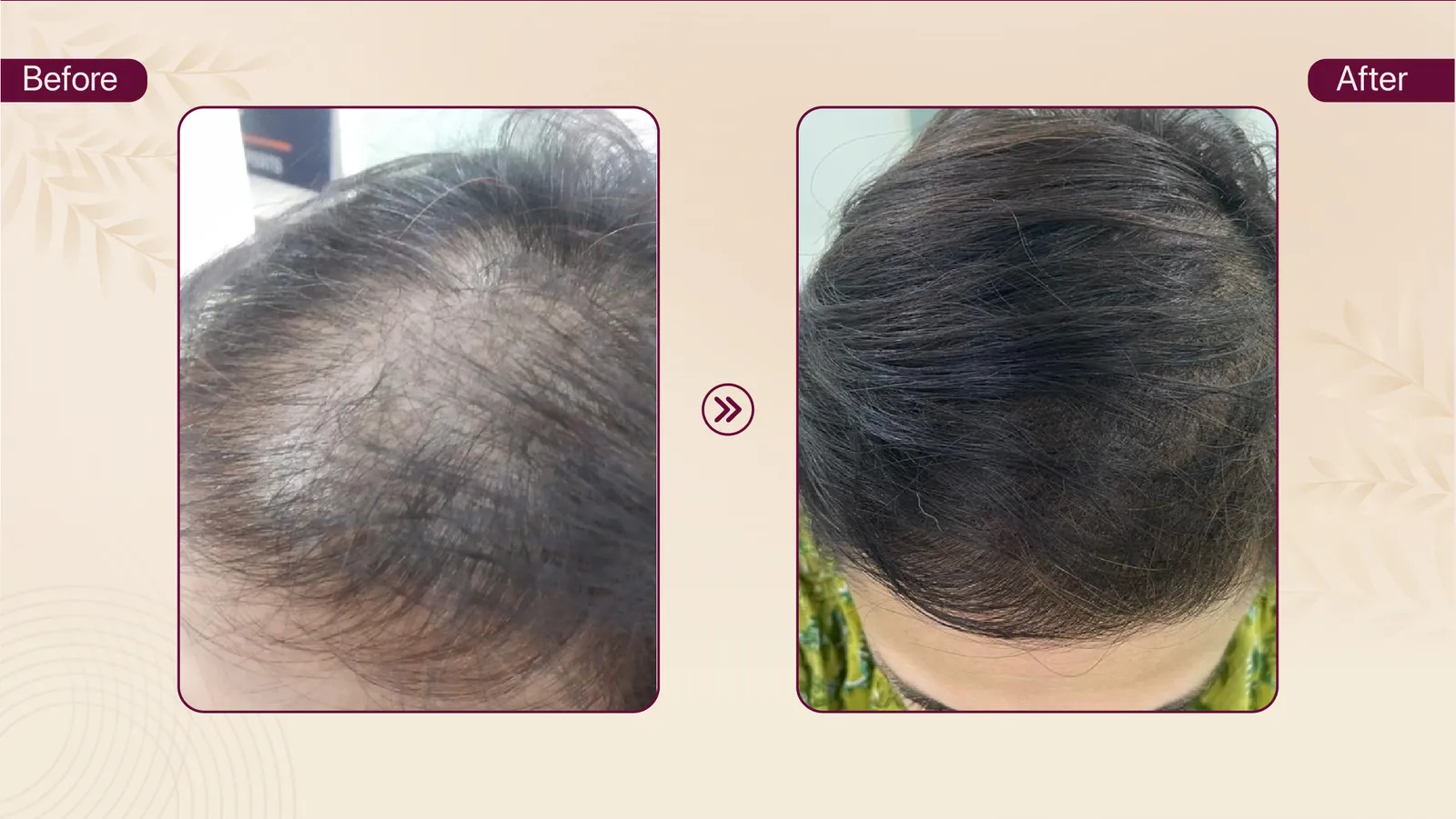 Female frontal hair density treatment journey