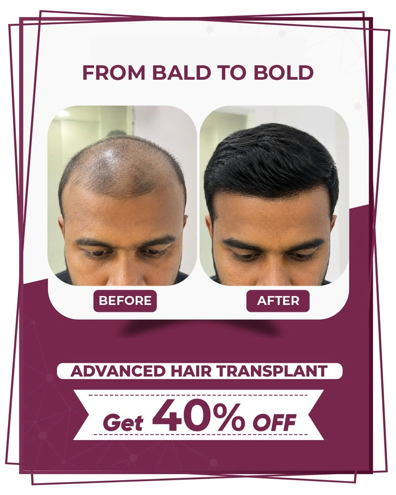 Layers Clinics advanced hair transplant offer 40% off from bald to bold