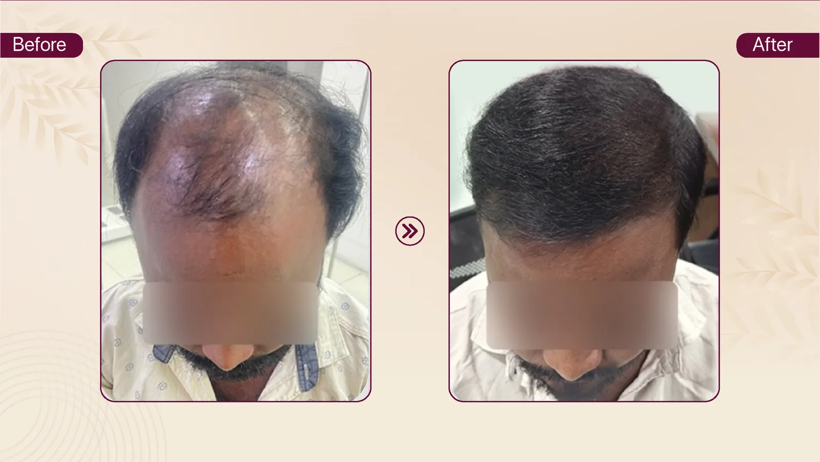 Hair transplant patient result 1 before and after