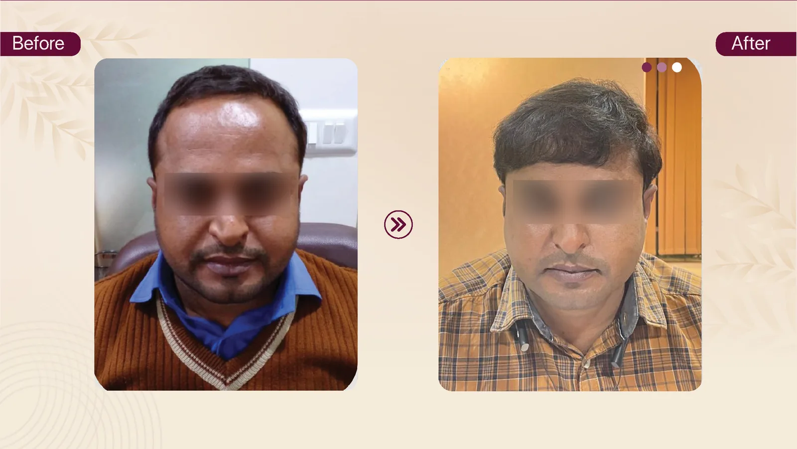 Hair transplant patient result 2 before and after