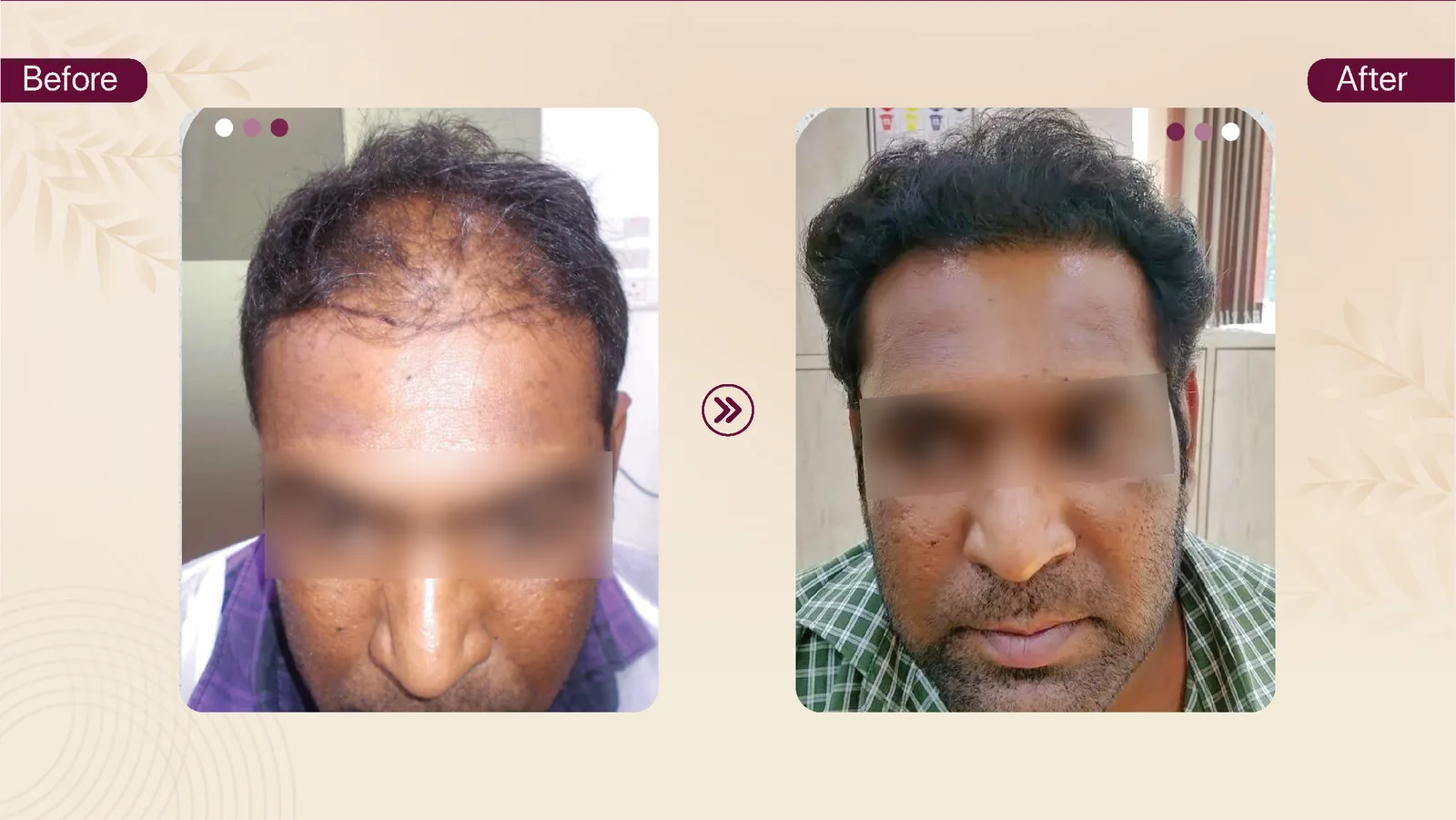 Hair transplant patient result 3 before and after