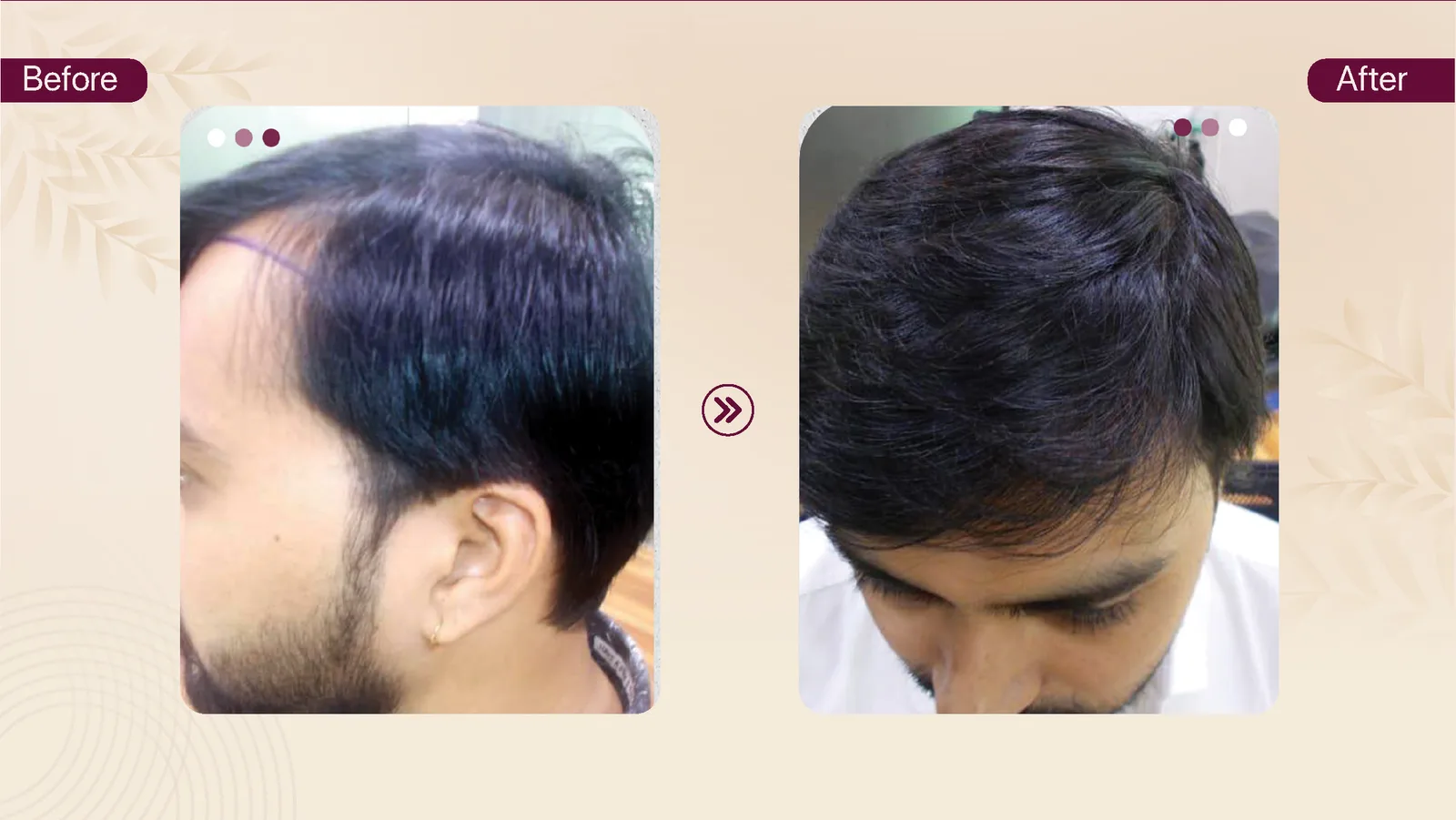 Hair transplant patient result 4 before and after