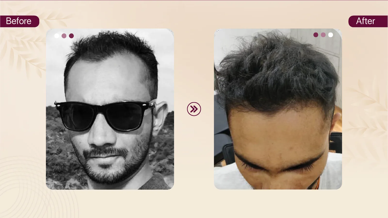 Hair transplant patient result 5 before and after