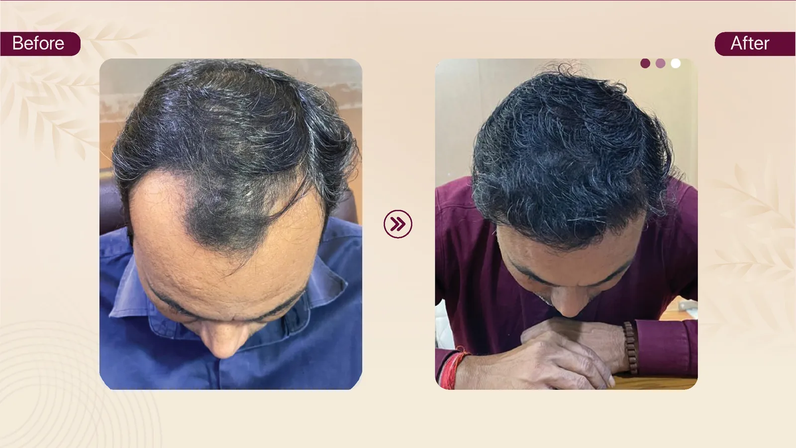Hair transplant patient result 6 before and after