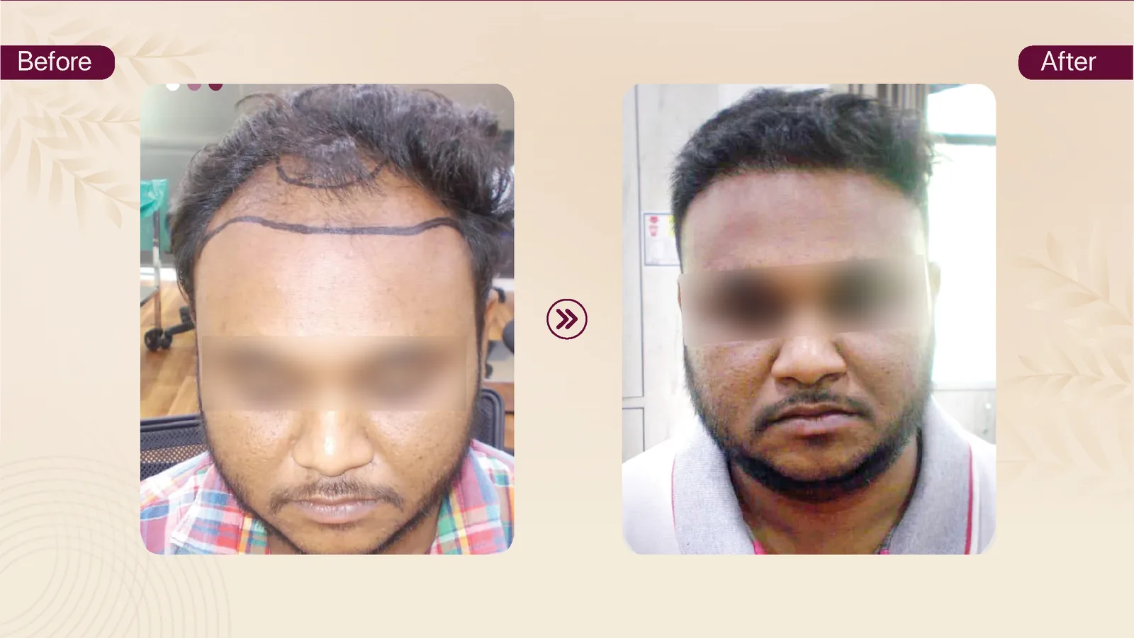 Hair transplant patient result 7 before and after