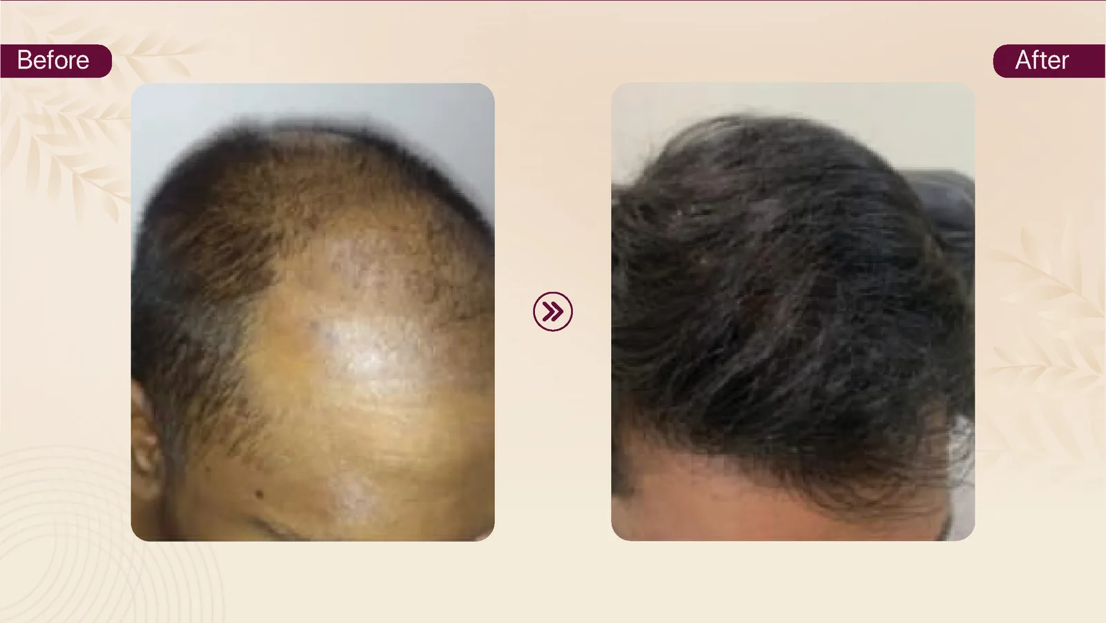 Hair transplant patient result 8 before and after