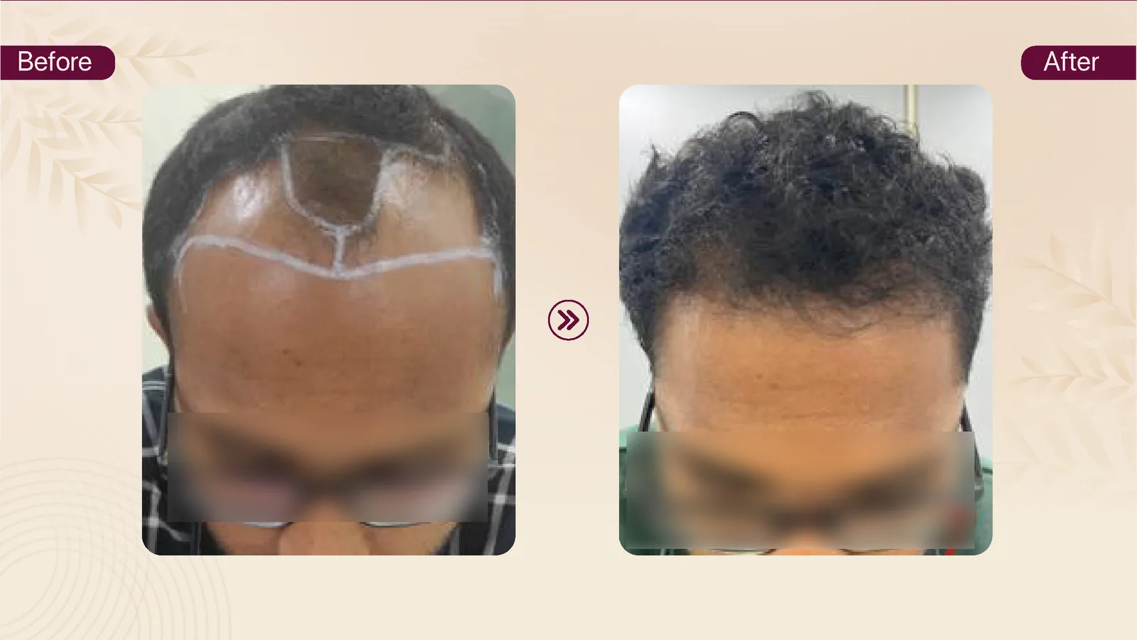 Hair transplant patient result 9 before and after