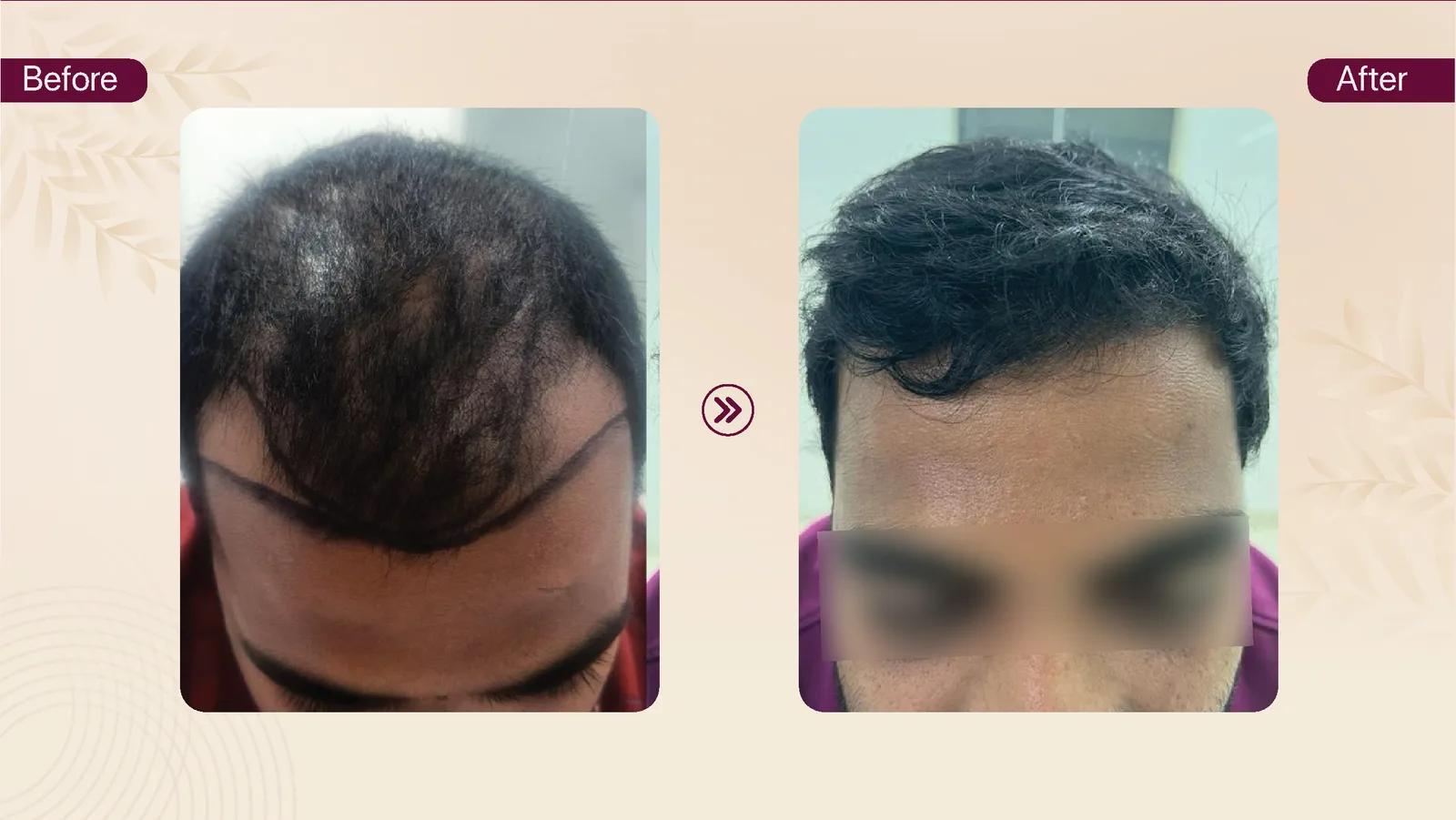 Hair transplant patient result 10 before and after