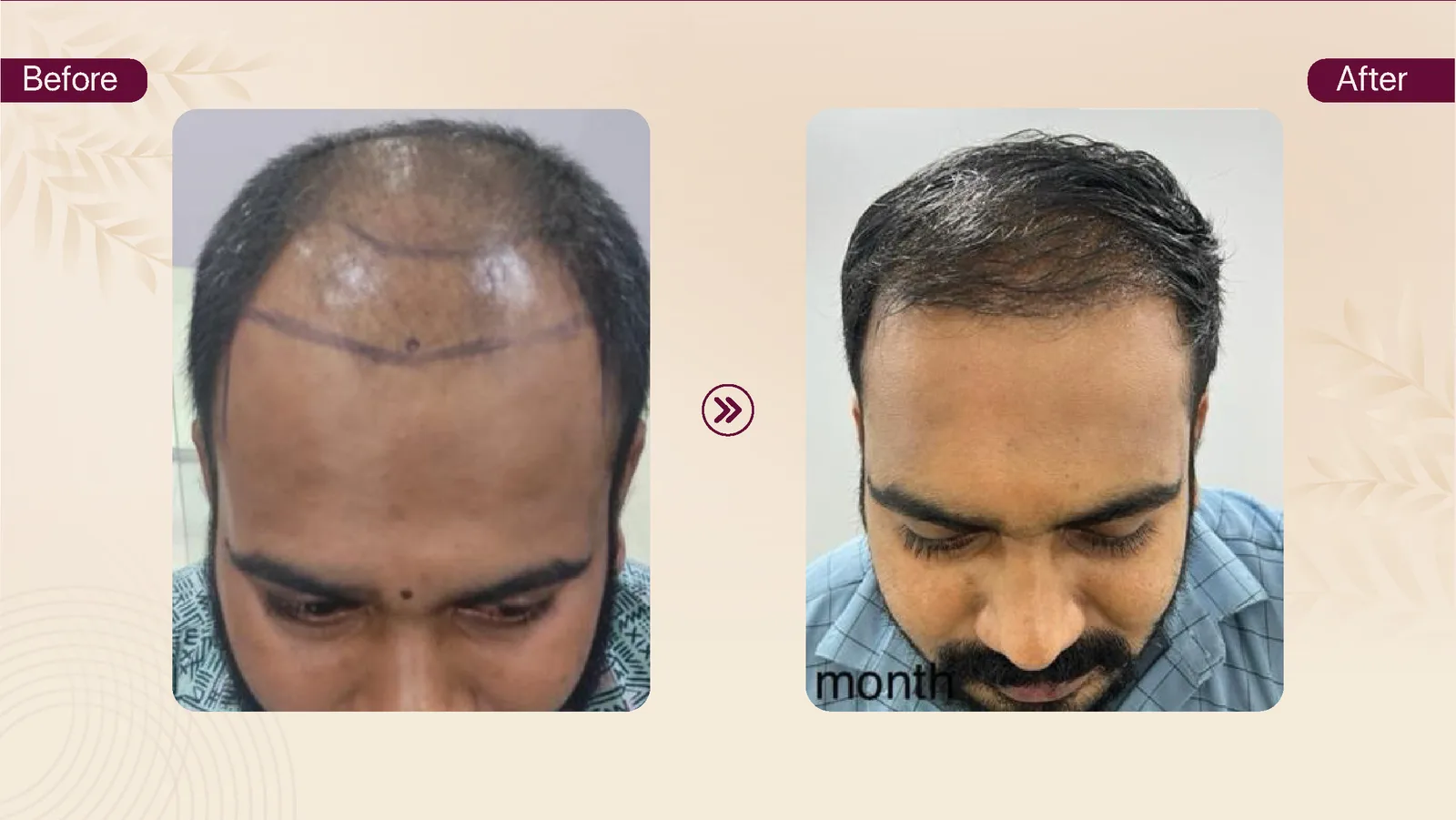 Hair transplant patient result 11 before and after