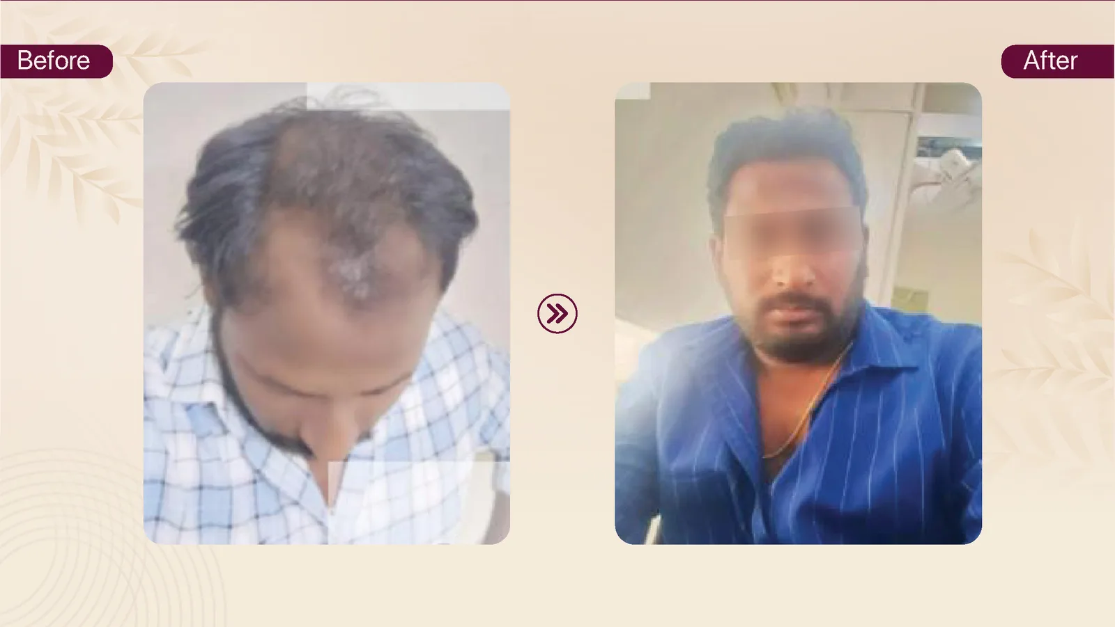 Hair transplant patient result 12 before and after