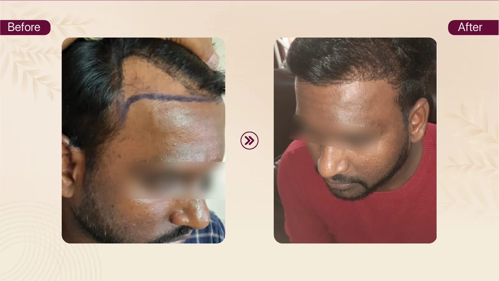 Hair transplant patient result 13 before and after