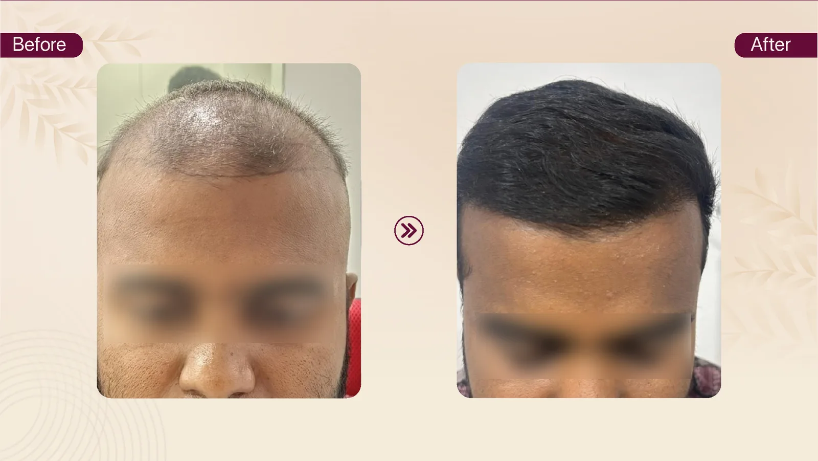 Hair transplant patient result 14 before and after