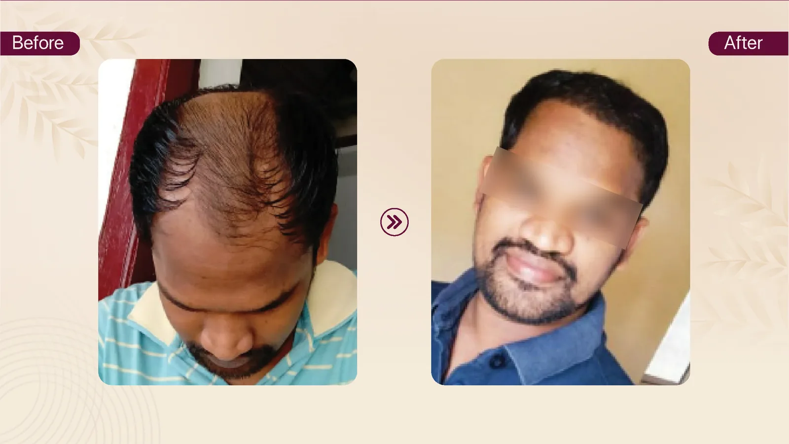Hair transplant patient result 15 before and after