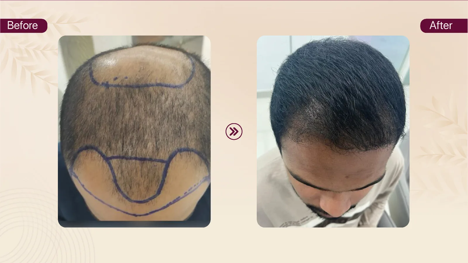 Hair transplant patient result 16 before and after