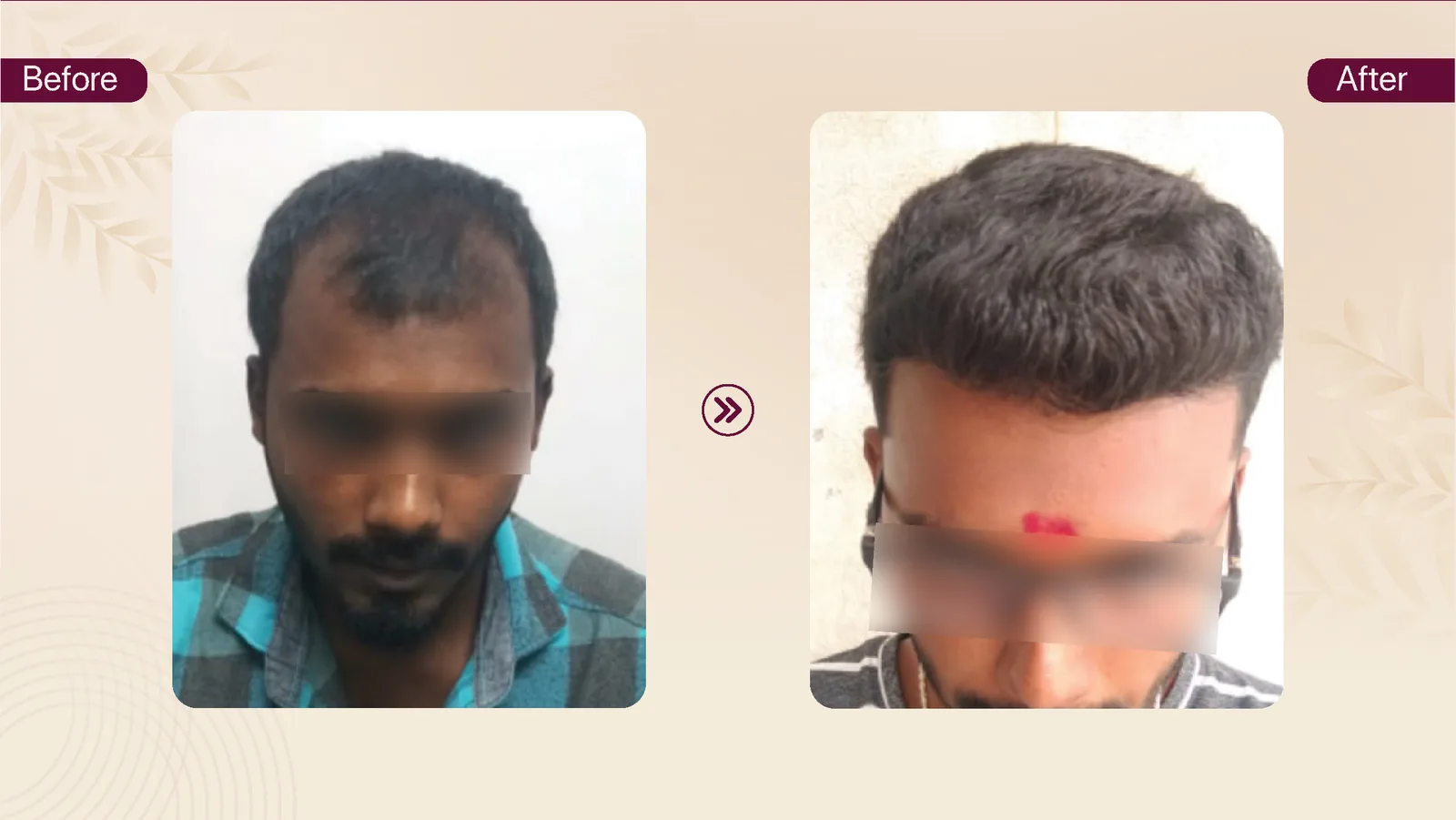 Hair transplant patient result 17 before and after