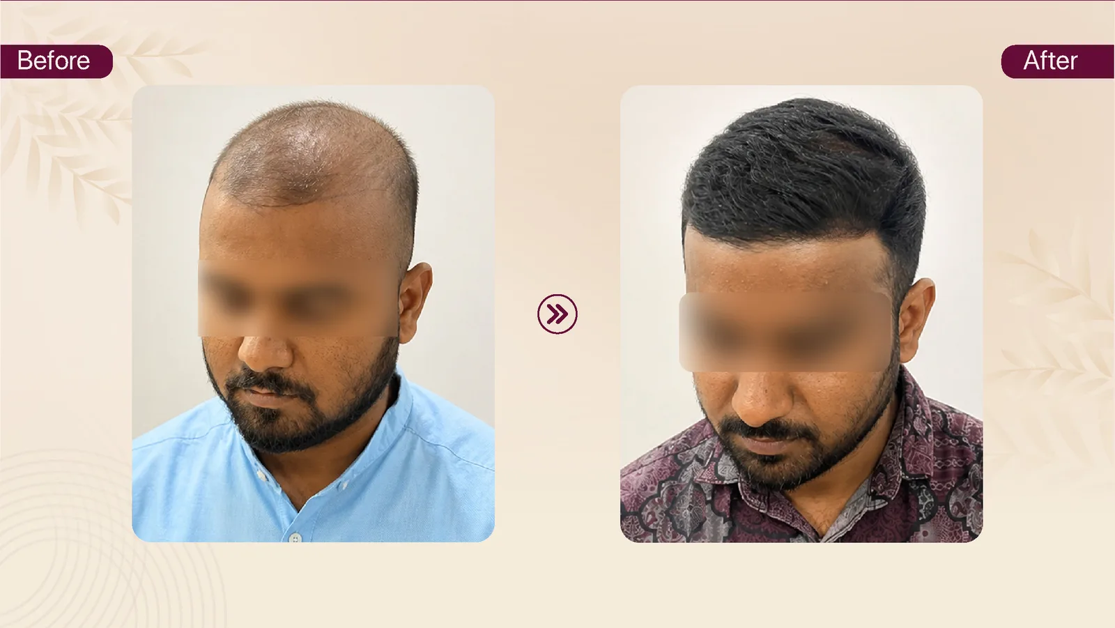 Hair transplant patient result 18 before and after